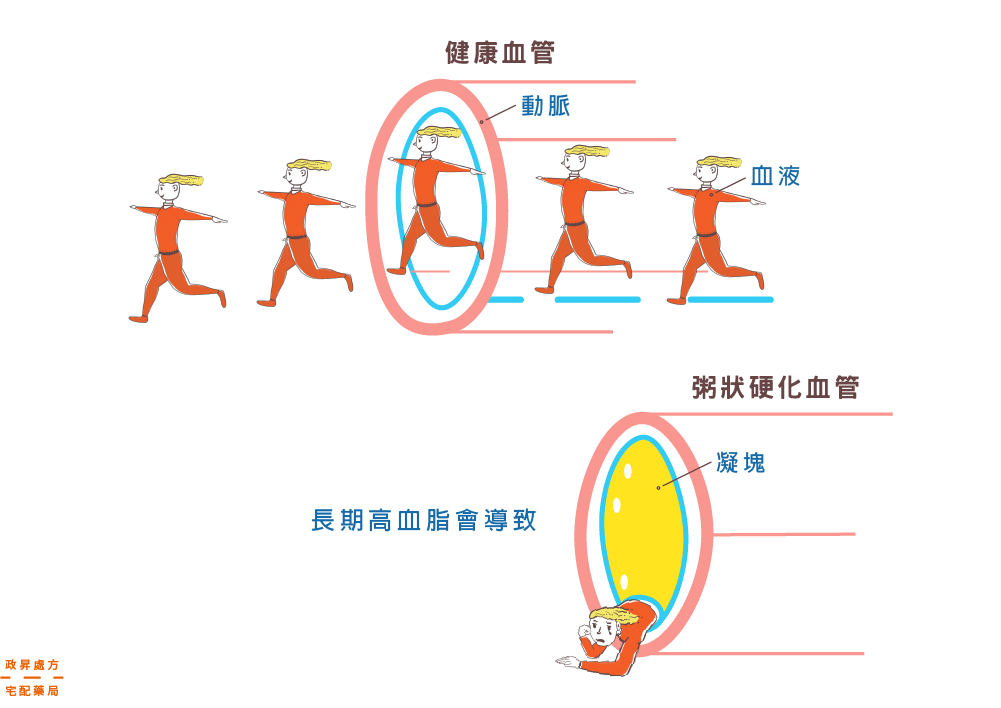 健康血管和粥狀動脈硬化血管的對比