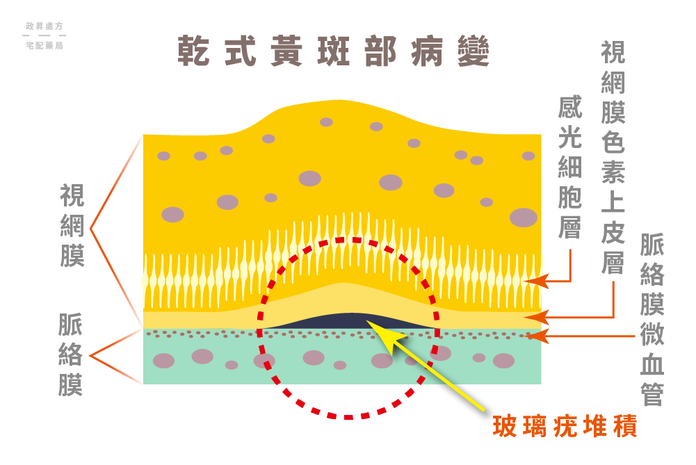 乾式黃斑部病變會出現玻璃疣堆積的情況