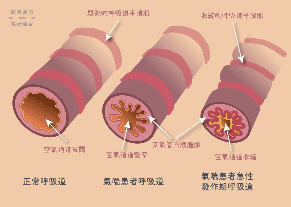 氣喘患者的呼吸道變化