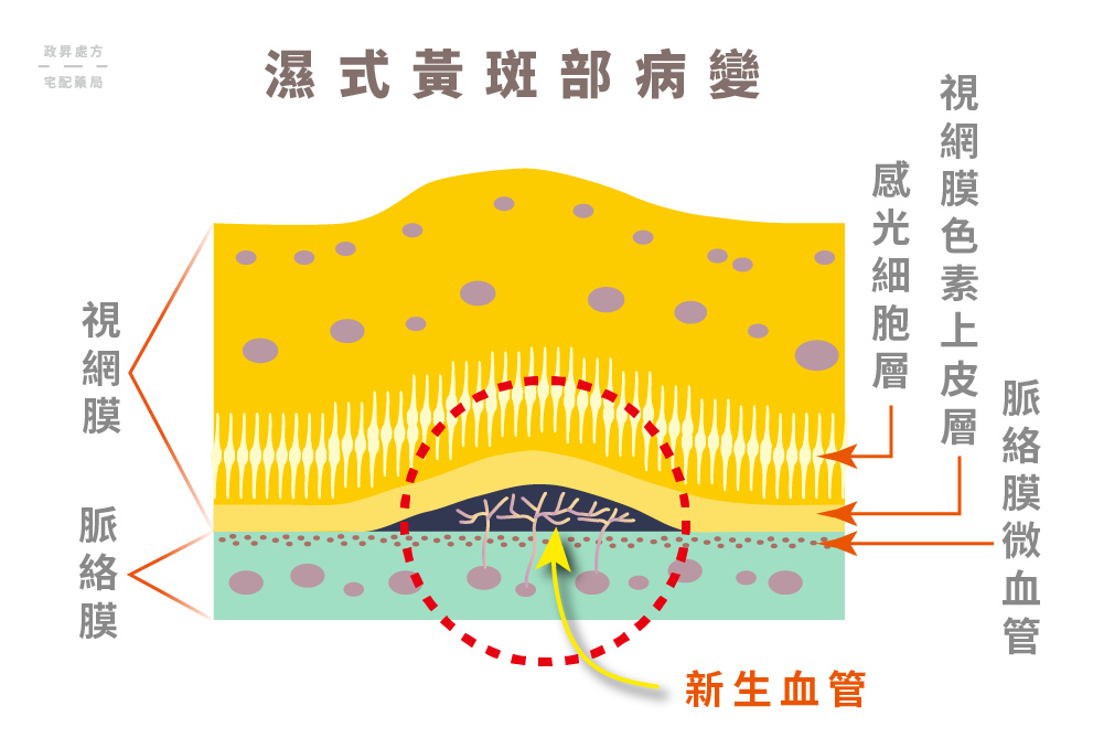 濕式黃斑部病變會出現不正常的新生血管