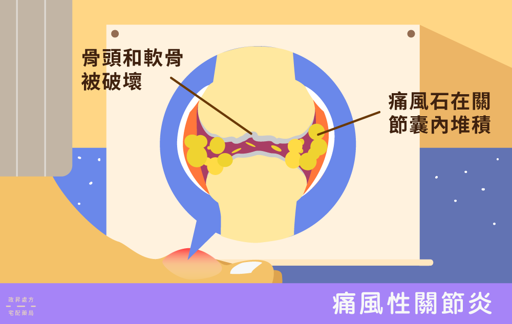 過多尿酸結晶累積在拇指關節，帶來疼痛