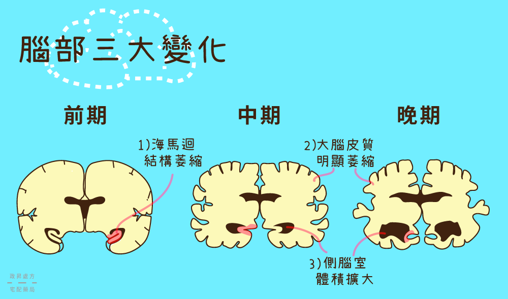 萎縮、受損、擴張都是阿茲海默症可能造成的腦部變化