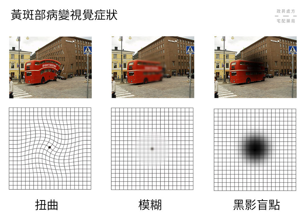 扭曲、模糊、黑影盲點是黃斑部病變的症狀