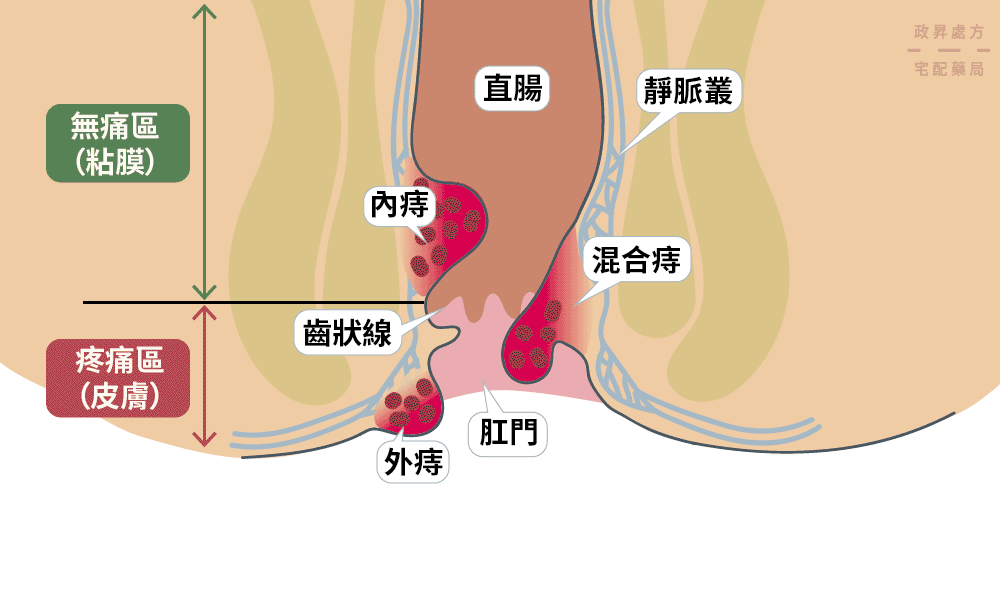 內痔、外痔、混合痔在肛門的分布位置