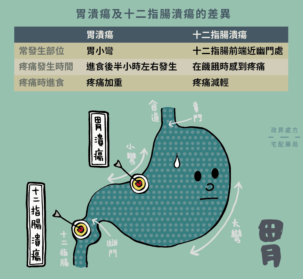 胃潰瘍與十二指腸潰瘍的差異有三種