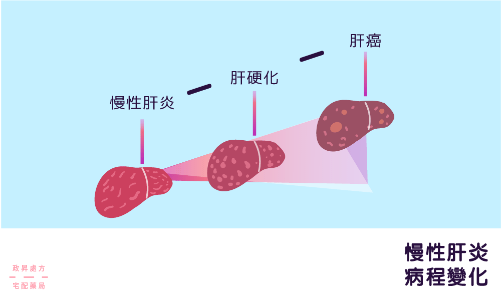 慢性肝炎的病程變化