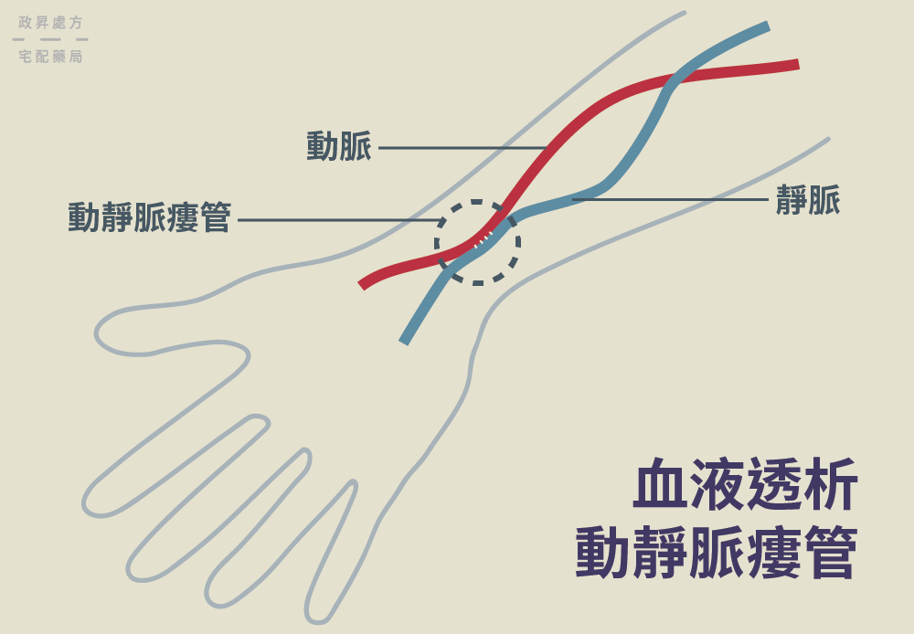 接合動脈與靜脈以創造自體瘻管