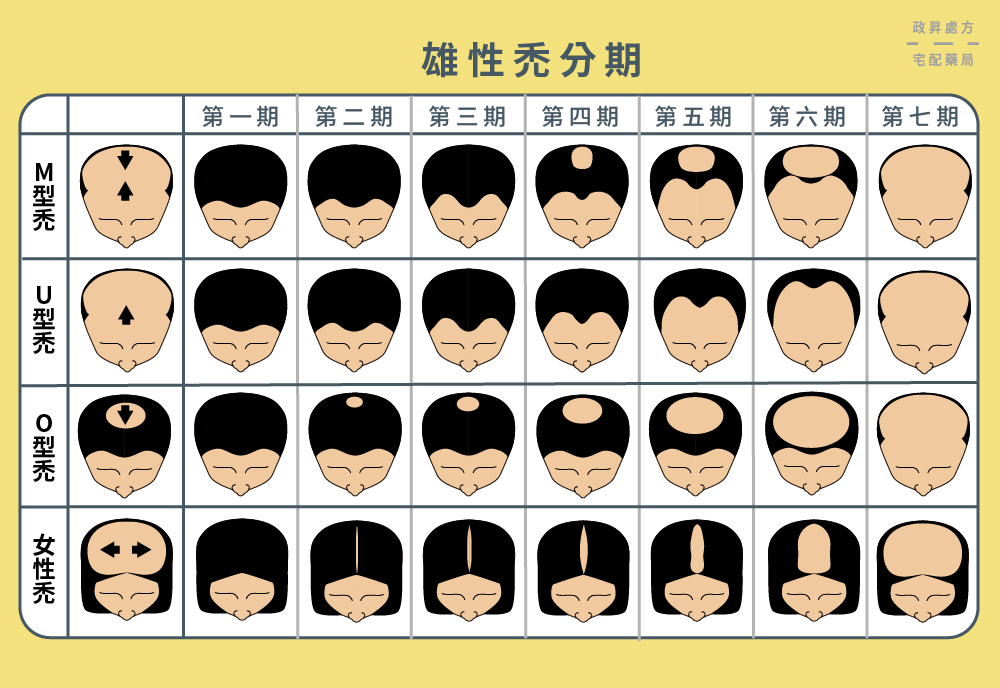 四種禿頭類型的髮量變化