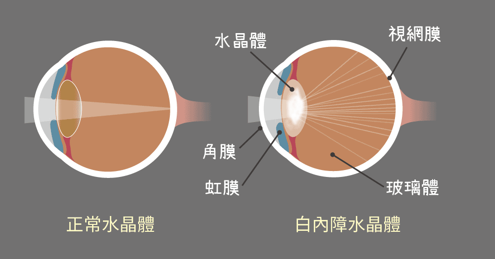 兩個眼球側面圖顯示水晶體變化