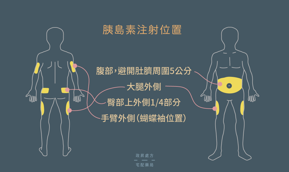 胰島素注射位置有腹部、大腿、上臂、臀部