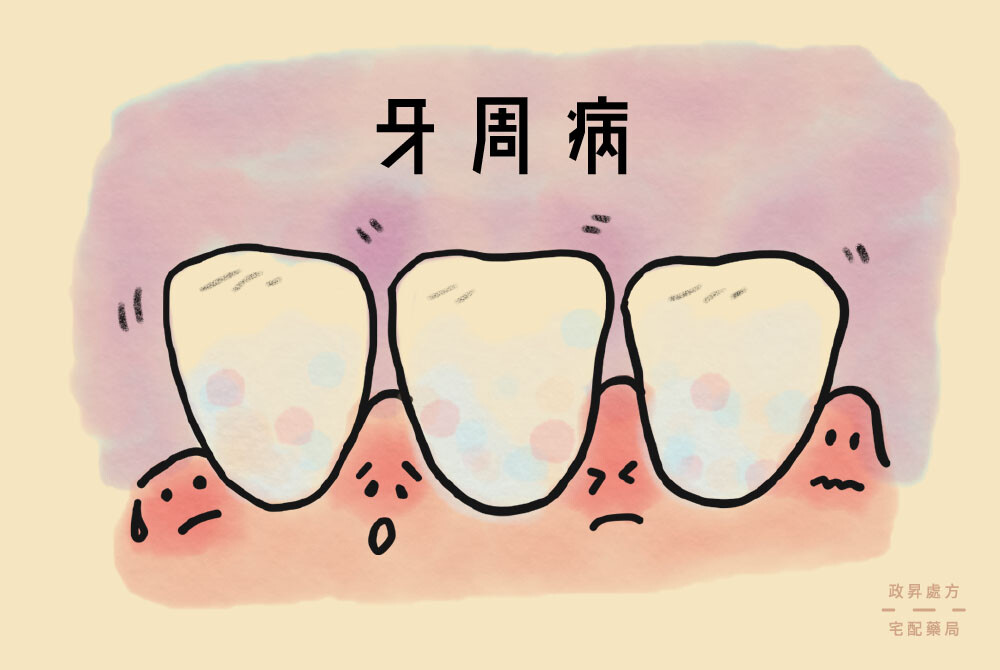 三顆牙齒與四個不同表情的紅腫牙齦示意牙周病
