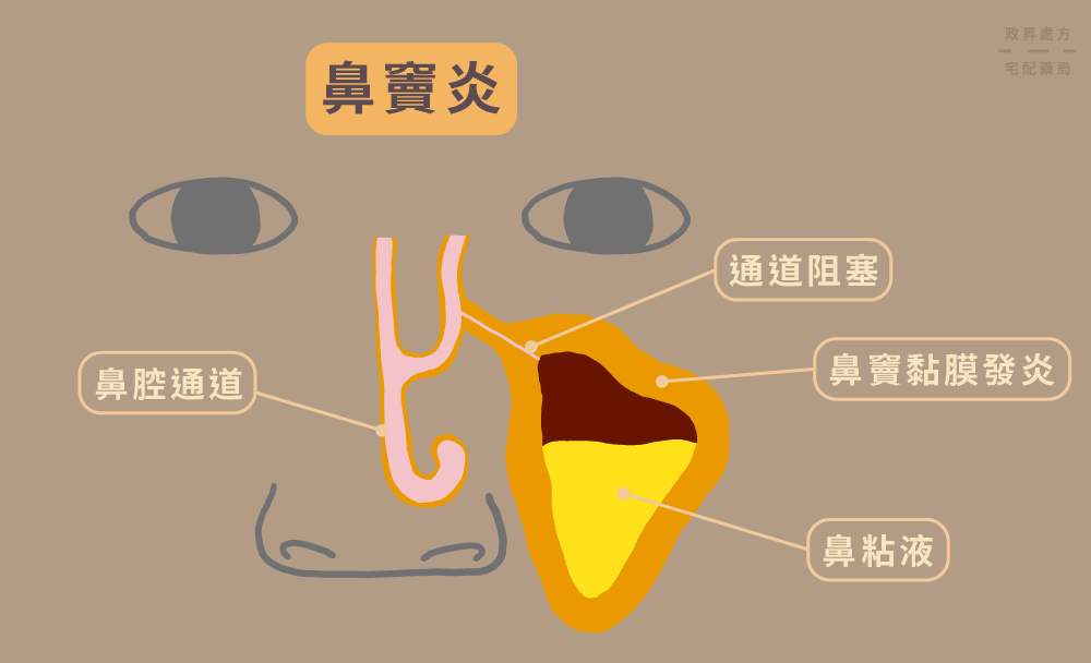 鼻竇構造與三種鼻竇炎原因