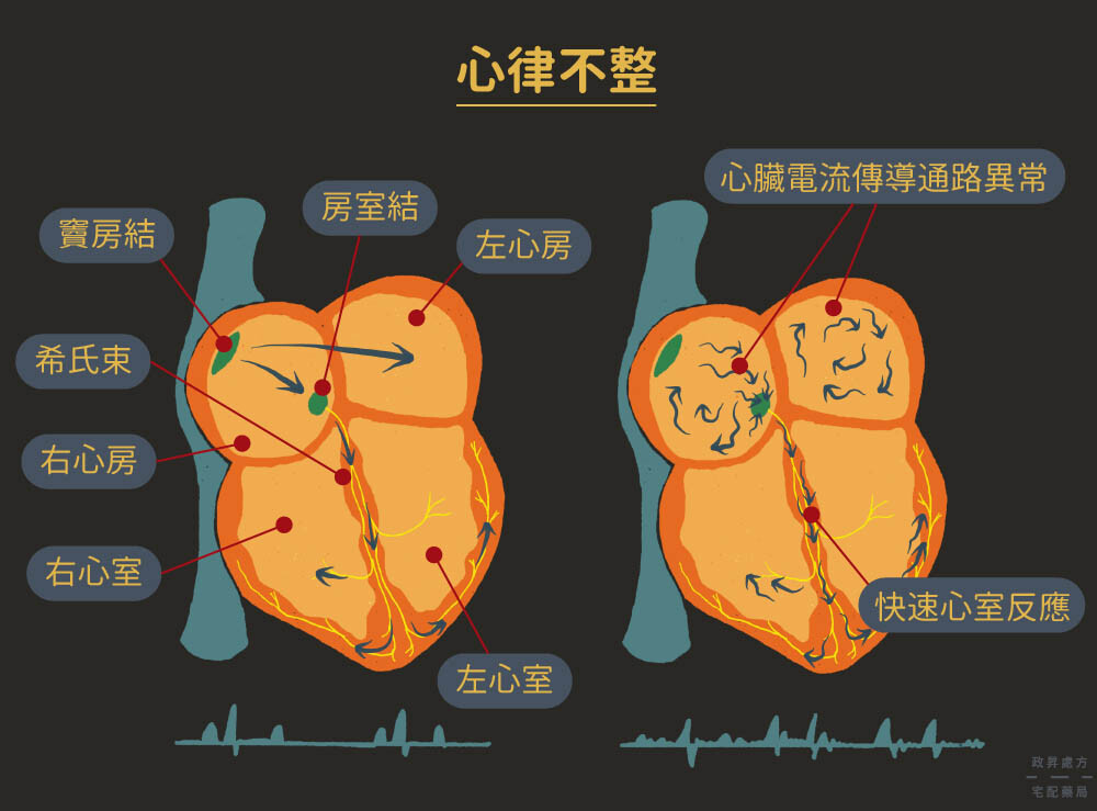 心律不整的心臟與正常心臟