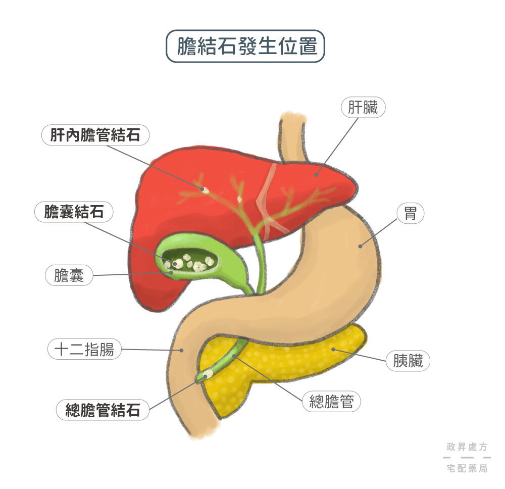 膽結石好發於肝內膽管、膽囊、總膽管