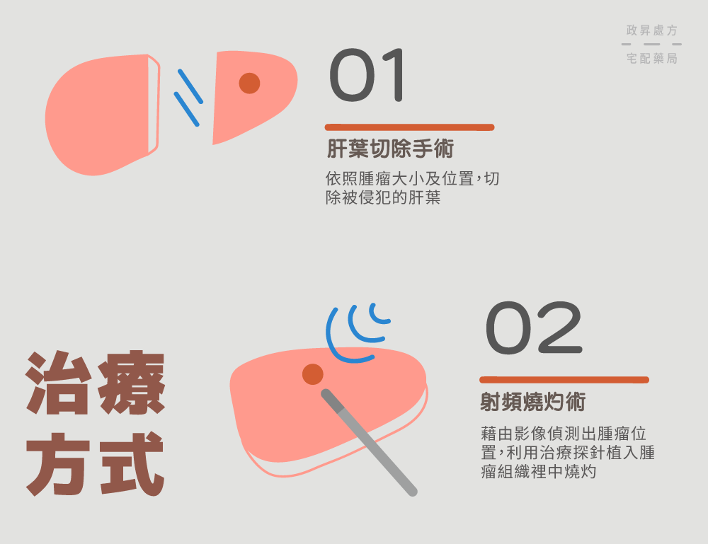 肝葉切除手術、射頻燒灼術介紹