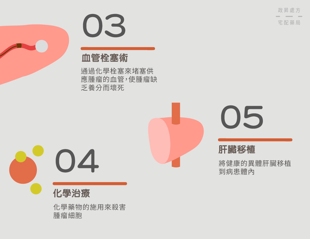 血管栓塞術、化學治療、肝臟移植介紹