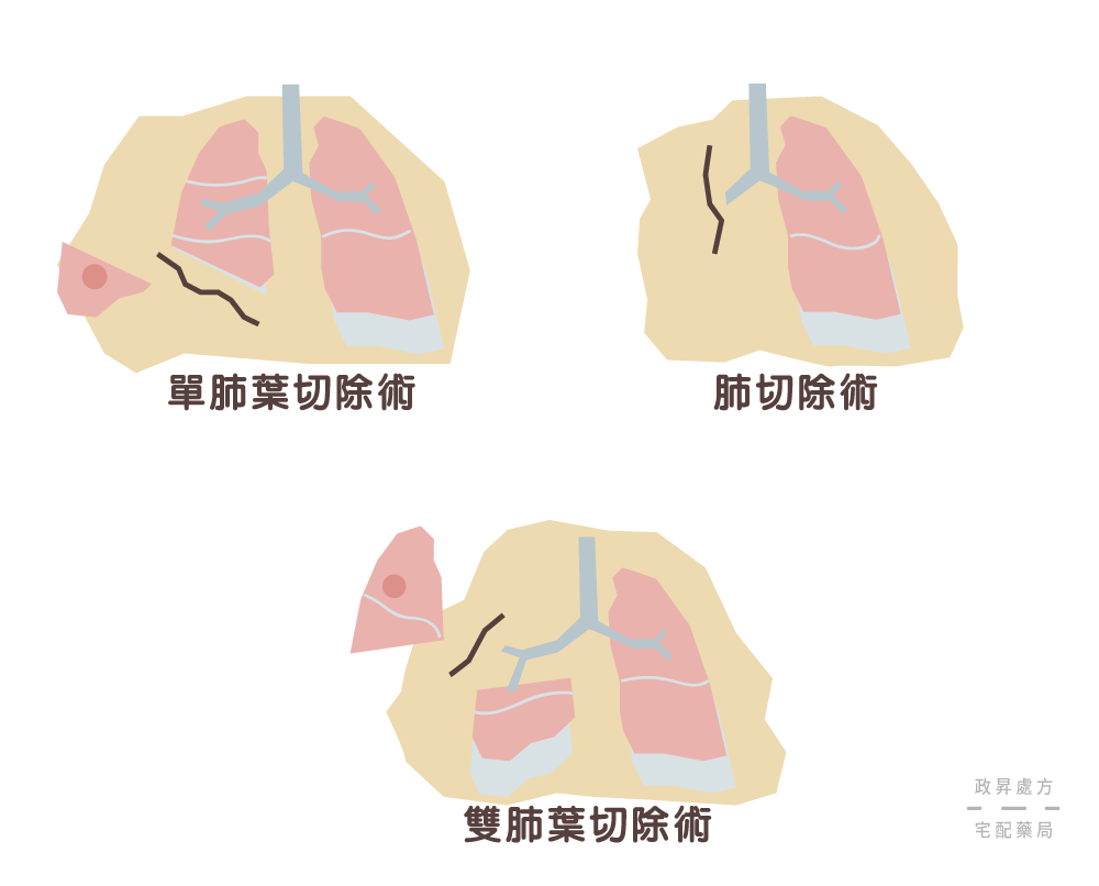 三種肺癌手術治療的方式