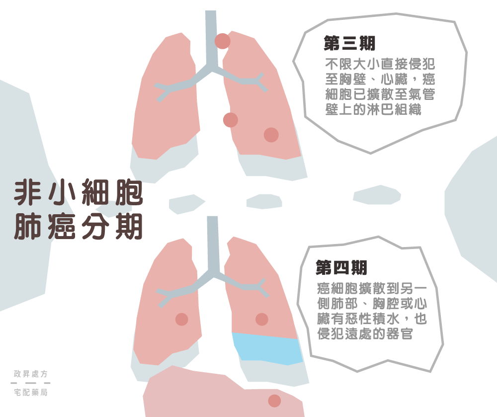 第三期與第四期肺癌的變化