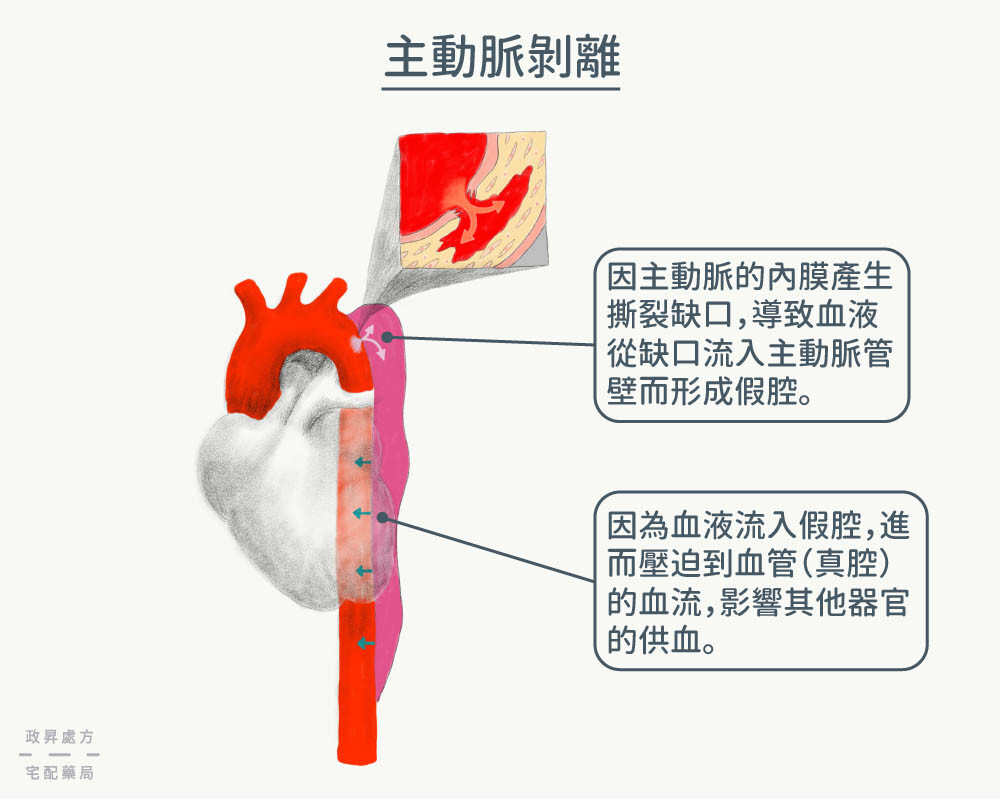 心臟與破裂滲血的主動脈