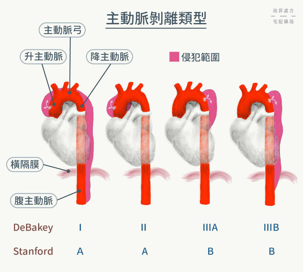 4 種主動脈剝離類型