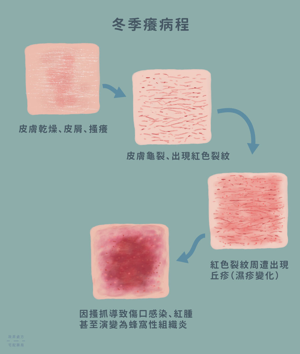 4 階段冬季癢病程