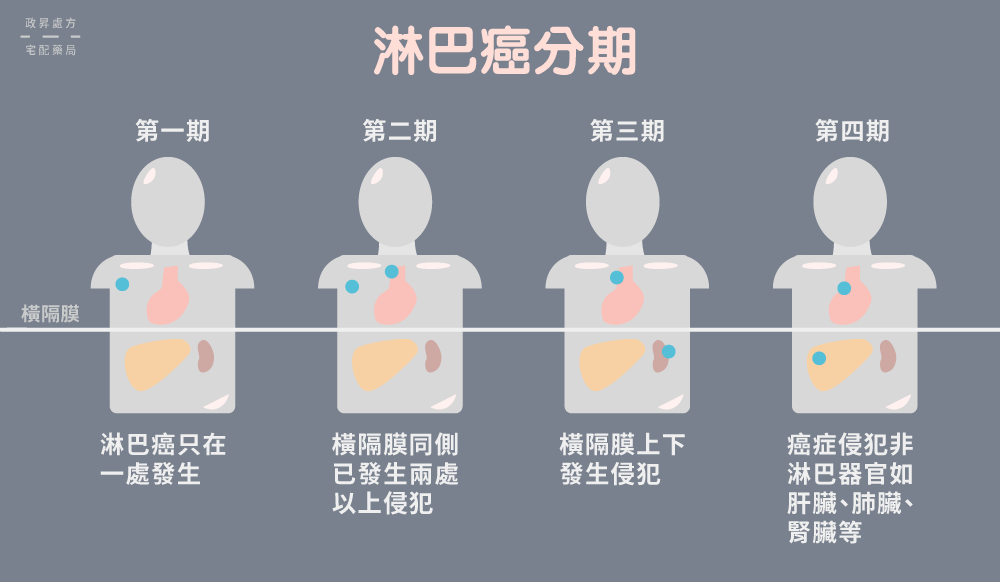 4 期淋巴癌侵襲範圍的人型