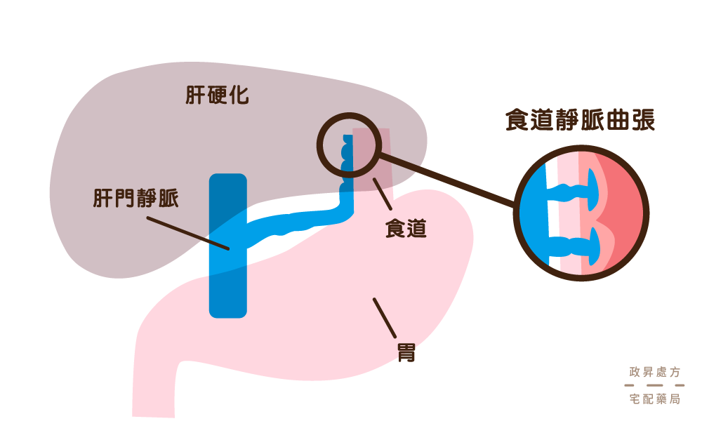 食道靜脈曲張的位置