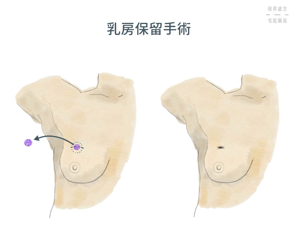 乳房保留手術介紹