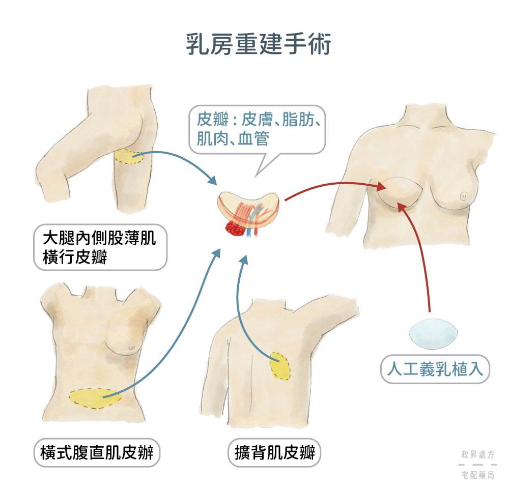 乳房重建手術說明