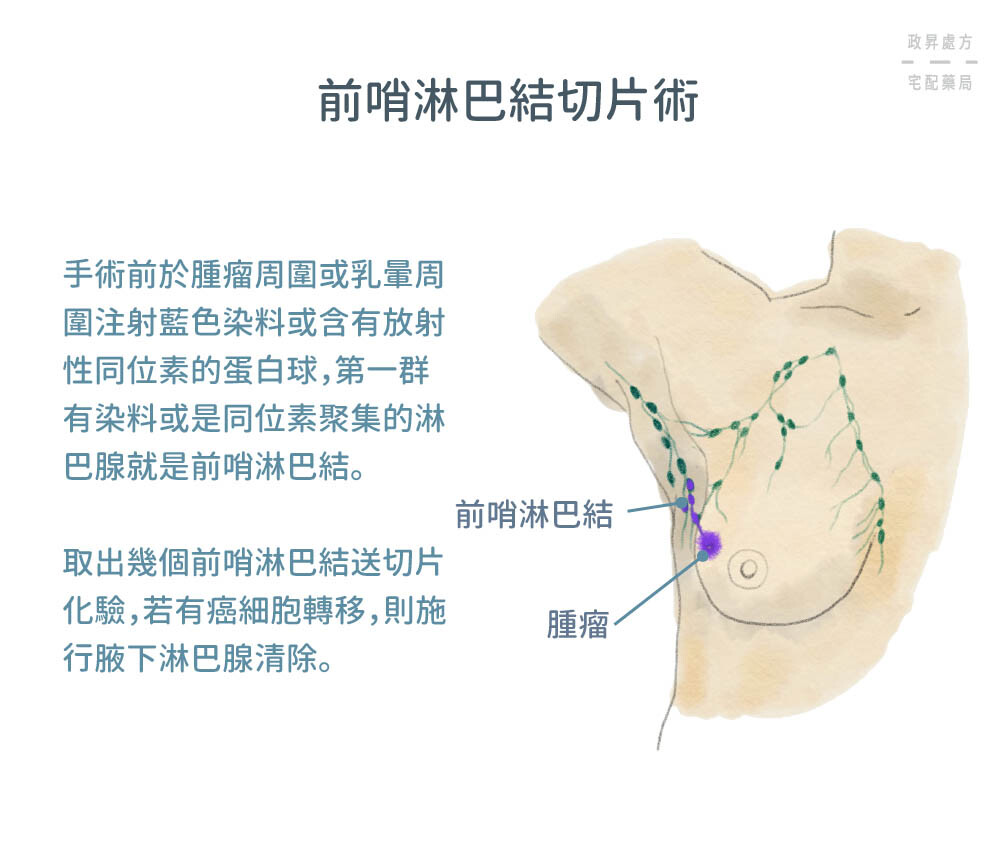 前哨淋巴結切片術介紹