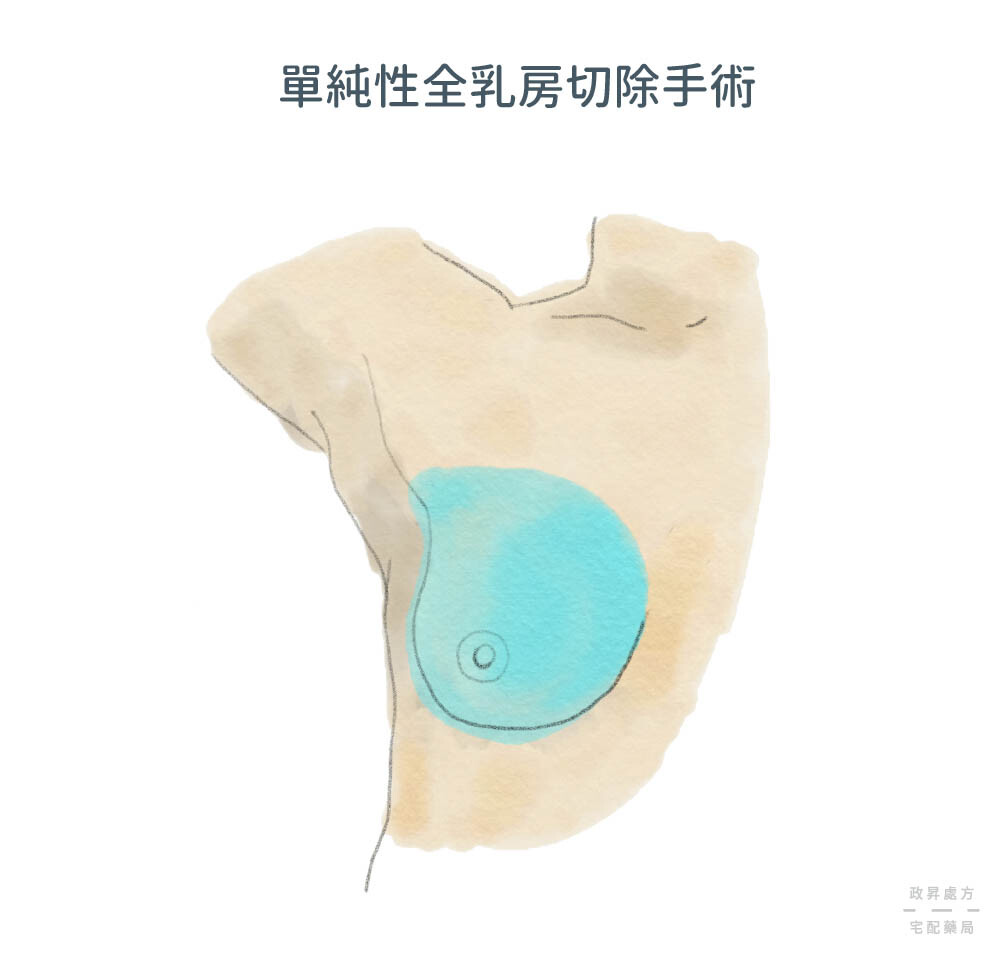 單純性全乳房切除手術介紹