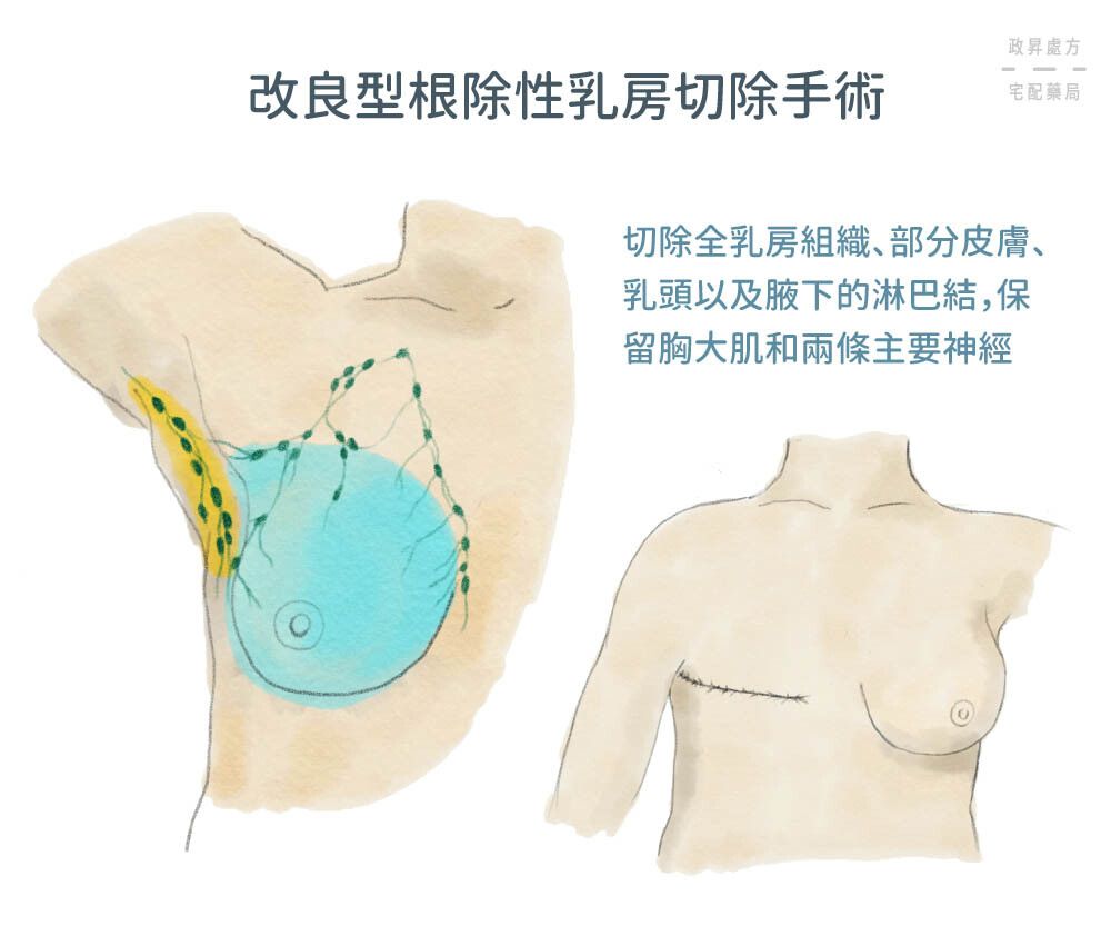 改良型根除性乳房切除手術介紹