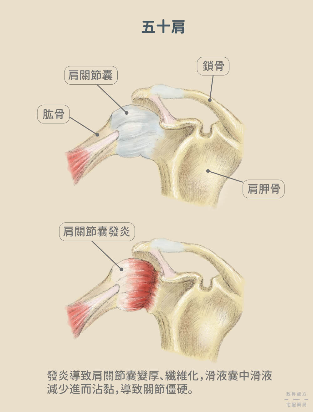 正常與發炎的肩關節骨骼