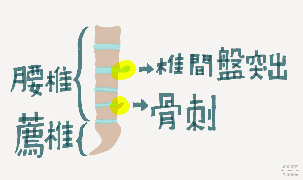 骨刺與椎間盤突出的差異