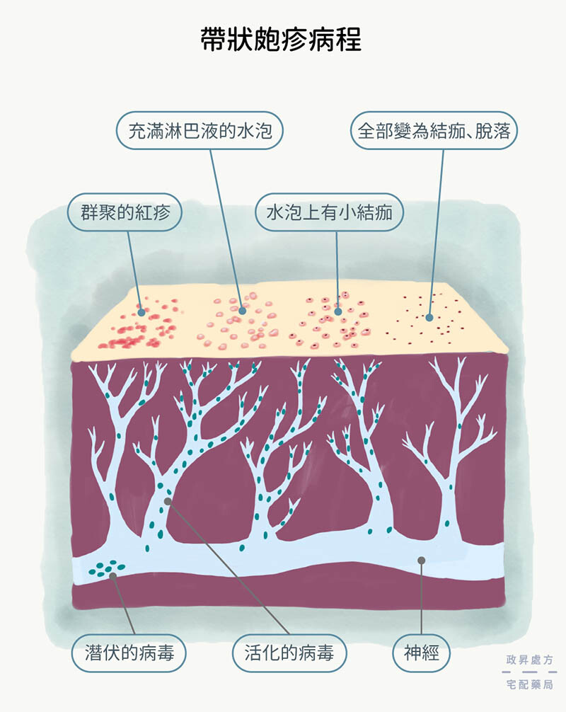 帶狀皰疹過程