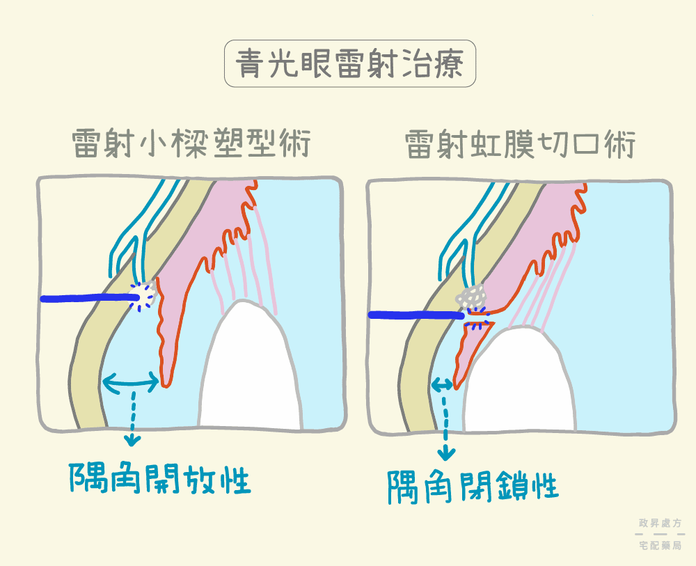 2種青光眼雷射治療方式