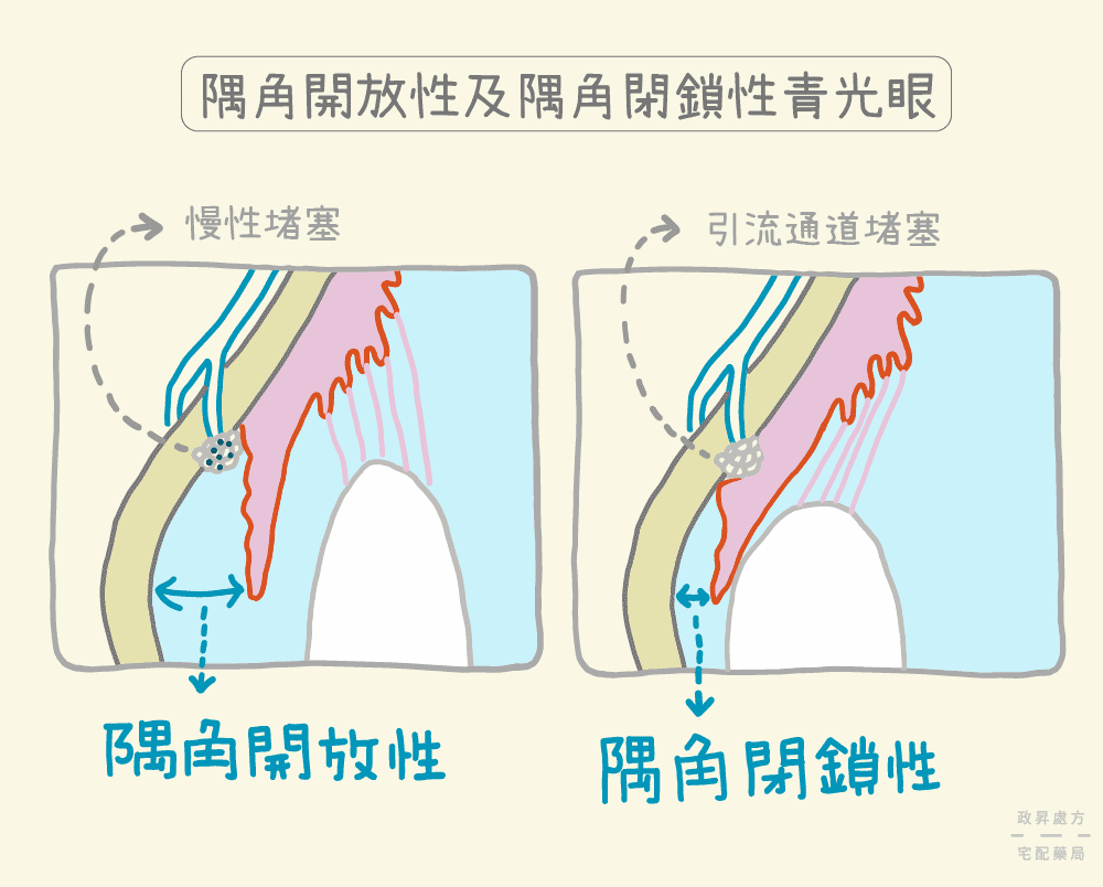 2種青光眼類型