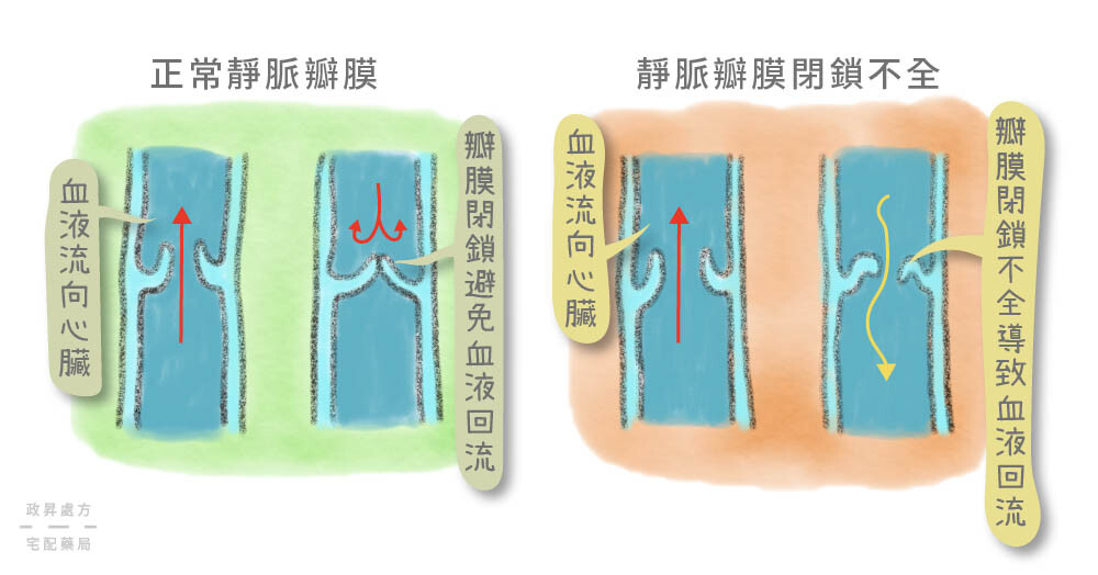 靜脈閉鎖不全的影響