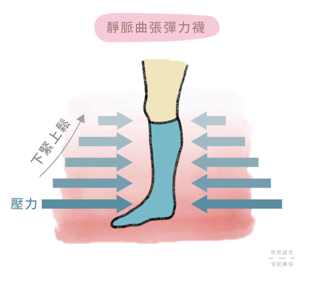 靜脈曲張彈性襪的原理