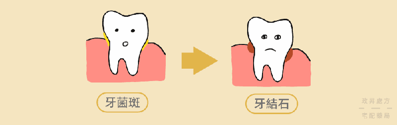 牙菌斑變牙結石造成牙周病