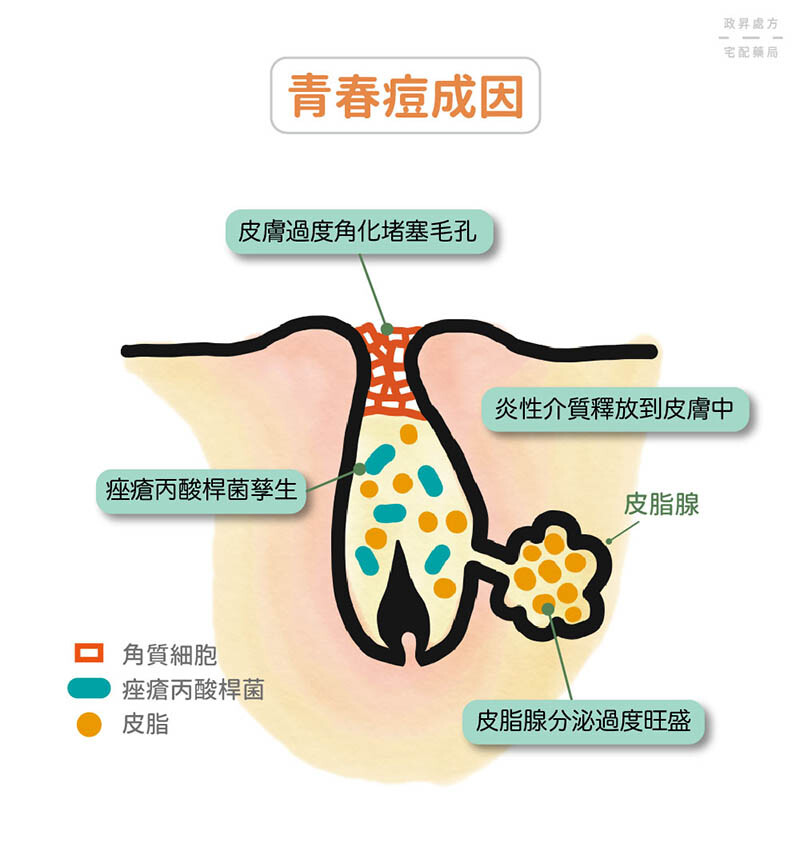 青春痘成因有皮膚過度角化皮脂腺分泌過度旺盛