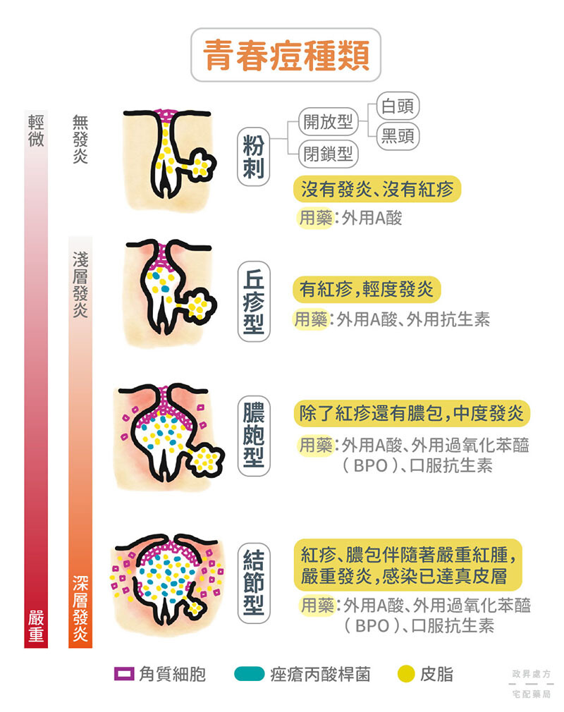 4種青春痘種類粉刺、丘疹型、膿皰型和結節型