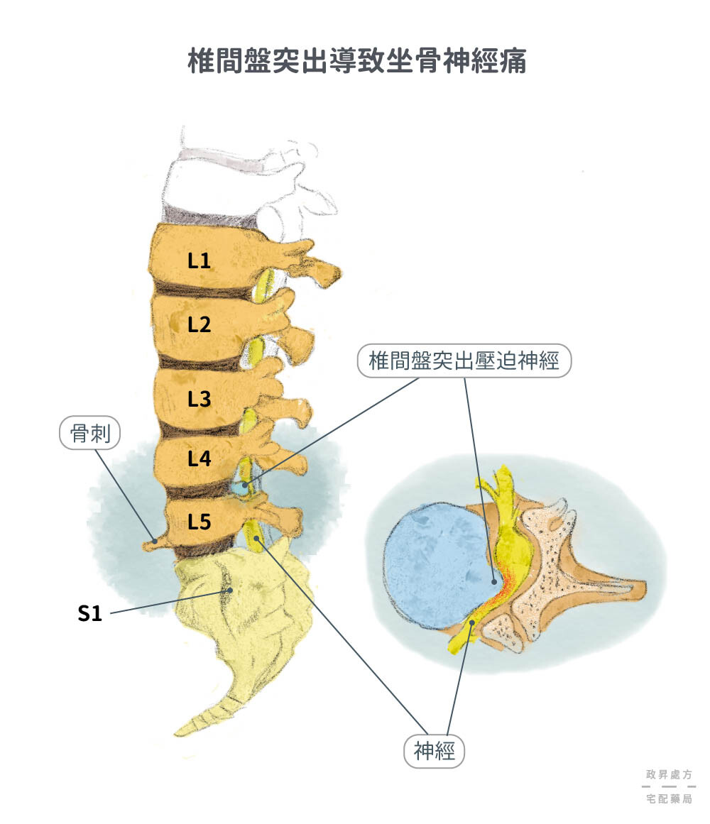 椎間盤突出的位置