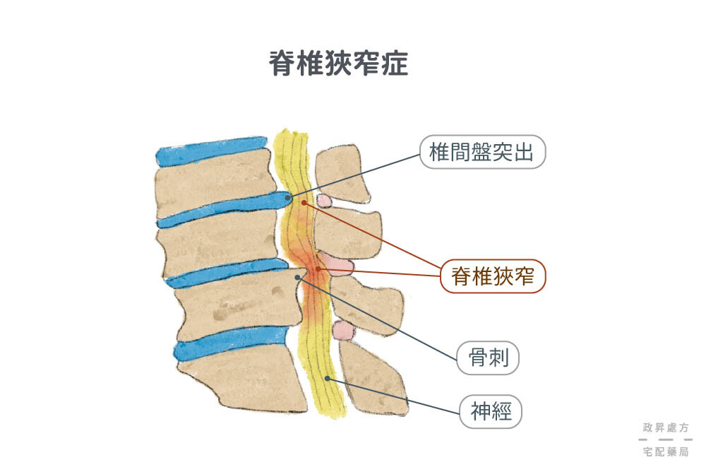 脊椎狹窄與骨刺