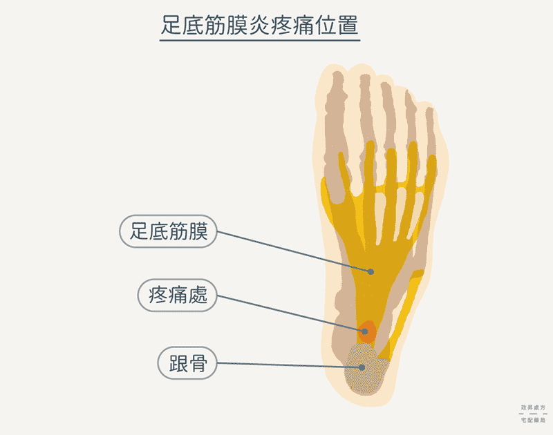 足底筋膜炎位置