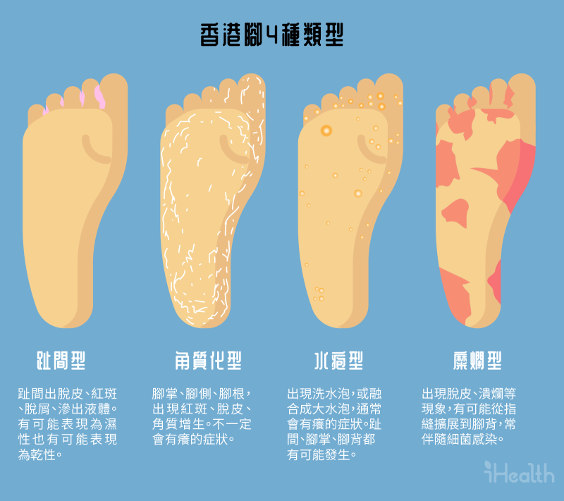 四種香港腳的類型