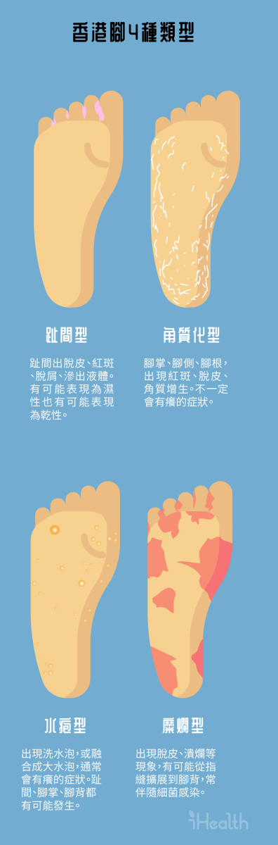 四種香港腳類型